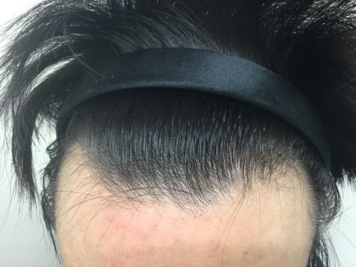 【23歳男性】生え際・頭頂部の薄毛がAGA治療で改善｜大阪梅田院