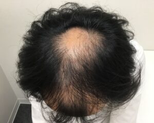 AGA治療前＿41歳男性＿生え際と頭頂部の薄毛＿大阪梅田院
