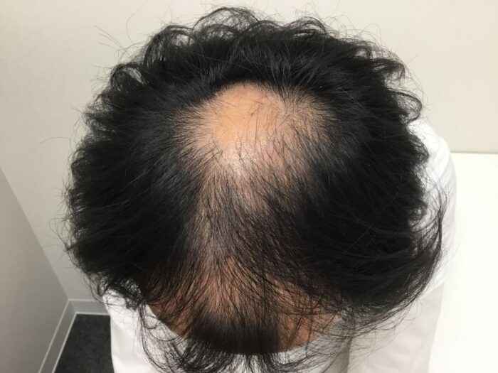 【41歳男性】生え際・頭頂部の薄毛がAGA治療で改善｜大阪梅田院