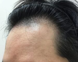 AGA治療前＿35歳男性＿生え際の薄毛＿大阪梅田院