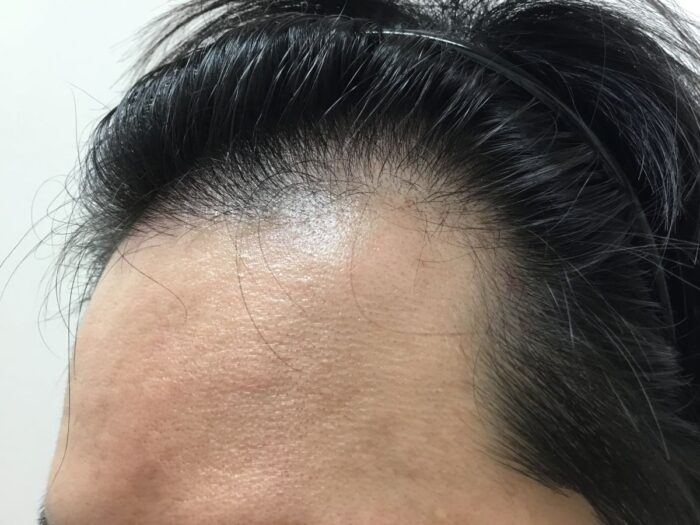 【35歳男性】生え際の薄毛がAGA治療で改善｜大阪梅田院
