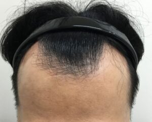 AGA治療前＿32歳男性＿生え際と頭頂部の薄毛＿大阪梅田院