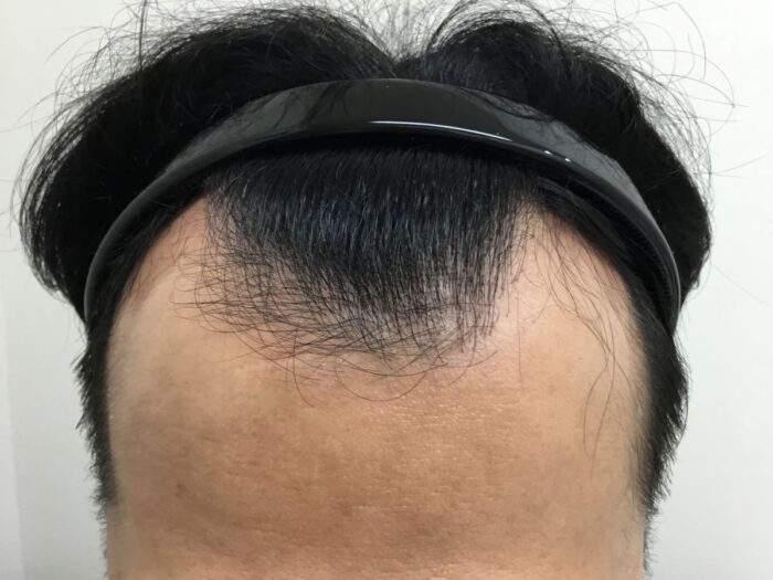 【32歳男性】生え際・頭頂部の薄毛がAGA治療で改善｜大阪梅田院