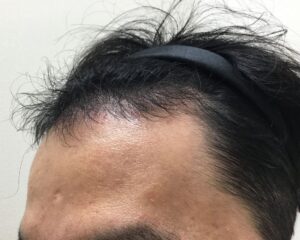 AGA治療前＿35歳男性＿生え際と頭頂部の薄毛＿大阪梅田院