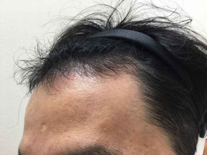 【35歳男性】生え際・頭頂部の薄毛がAGA治療で改善｜大阪梅田院