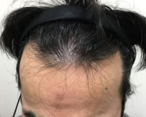 AGA治療前_56歳男性_生え際と頭頂部の薄毛_大阪梅田院