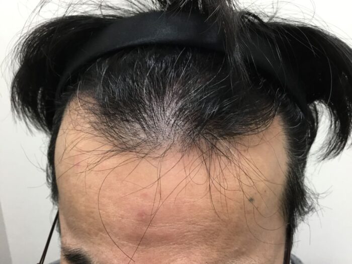 【56歳男性】生え際・頭頂部の薄毛がAGA治療で改善｜大阪梅田院