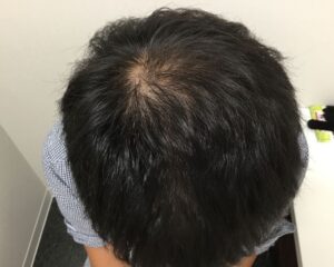 AGA治療前＿43歳男性＿頭頂部の薄毛＿大阪梅田院
