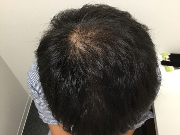 【43歳男性】頭頂部の薄毛がAGA治療で改善｜大阪梅田院