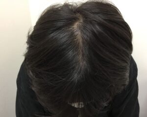 AGA治療前＿27歳男性＿頭頂部の薄毛＿大阪梅田院