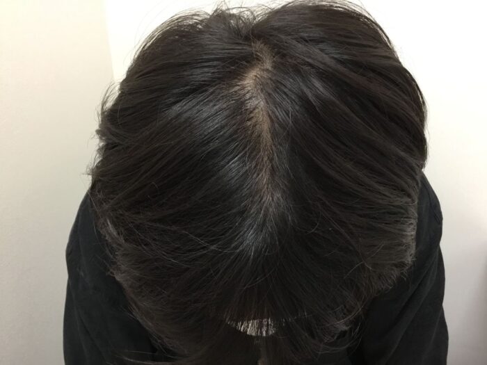 【27歳男性】頭頂部の薄毛がAGA治療で改善｜大阪梅田院