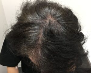 AGA治療前＿42歳男性＿生え際と頭頂部の薄毛＿大阪梅田院