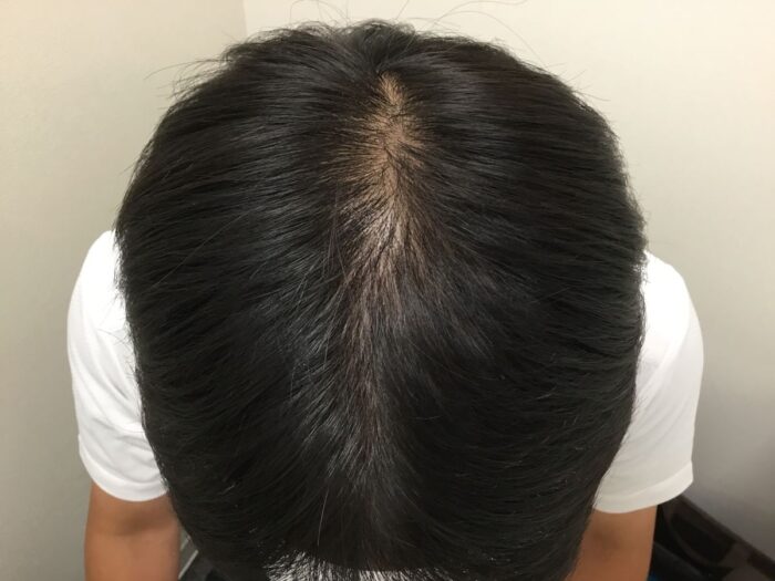 【31歳男性】頭頂部・生え際の薄毛がAGA治療で改善｜大阪梅田院