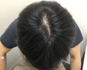 AGA治療前_41歳男性_生え際と頭頂部の薄毛_大阪梅田院