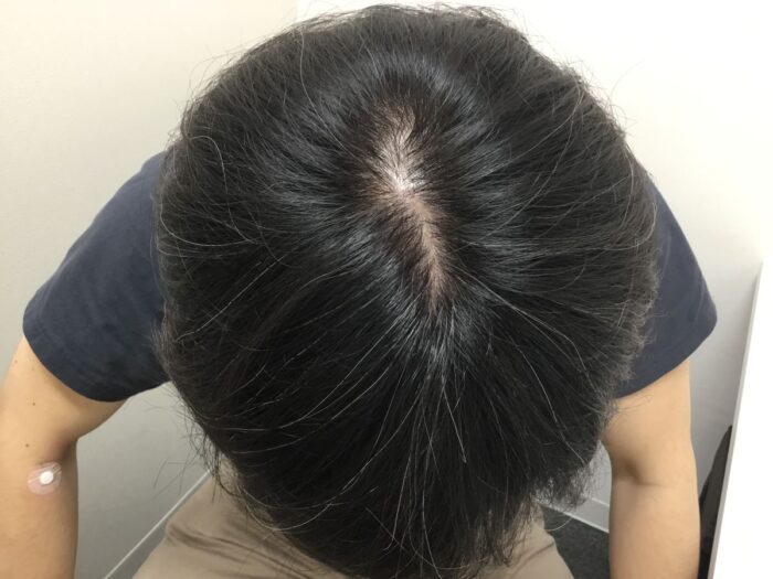 【41歳男性】生え際・頭頂部の薄毛がAGA治療で改善｜大阪梅田院