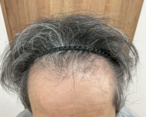 AGA治療前＿52歳男性＿生え際と頭頂部の薄毛＿広島院
