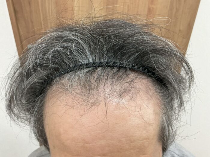 【52歳男性】生え際・頭頂部の薄毛がAGA治療で改善｜広島院