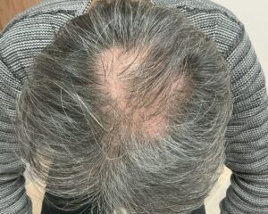 AGA治療前＿53歳男性＿頭頂部のＡＧＡ＋多発型円形脱毛症＿広島院