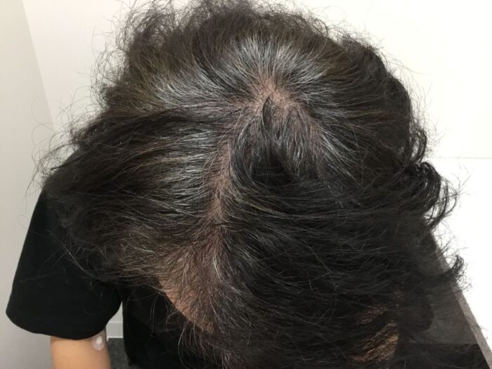 【42歳男性】生え際・頭頂部の薄毛がAGA治療で改善｜大阪梅田院