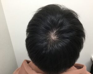 AGA治療前＿20歳男性＿生え際と頭頂部の薄毛＿大阪梅田院