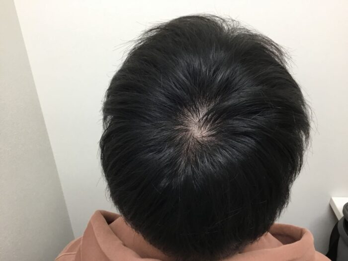 【20歳男性】生え際・頭頂部の薄毛がAGA治療で改善｜大阪梅田院