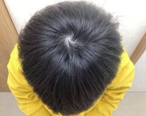AGA治療6ヵ月経過　29歳男性　頭頂部　横浜院