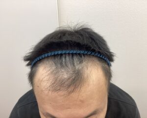 AGA治療前　47歳男性　生え際・頭頂部薄毛　新潟院