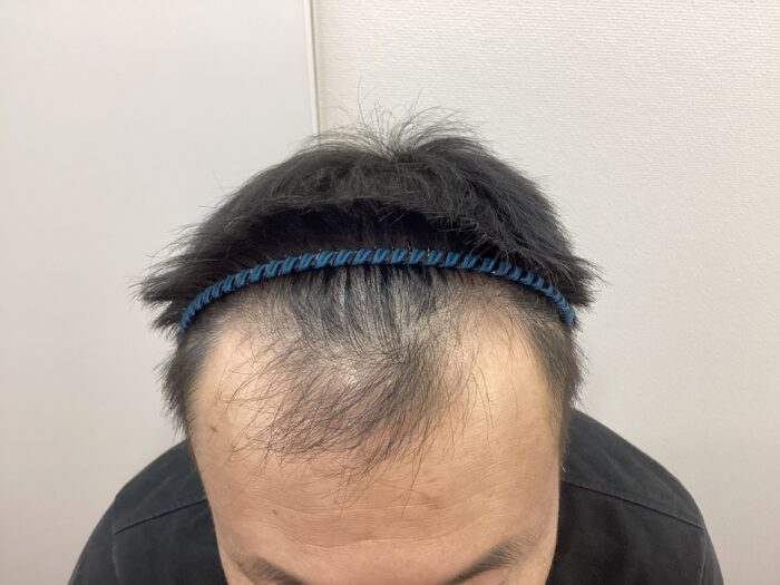 【47歳男性】生え際・頭頂部の薄毛がAGA治療で改善｜新潟院