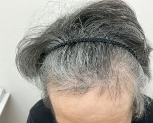 AGA治療後＿52歳男性＿生え際と頭頂部の改善＿広島院