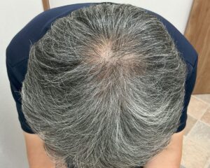 ＡＧＡ治療後_53歳男性＿頭頂部のＡＧＡ＋多発型円形脱毛症の改善_広島院