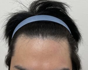AGA治療前　38歳男性　生え際・頭頂部薄毛　岡山院