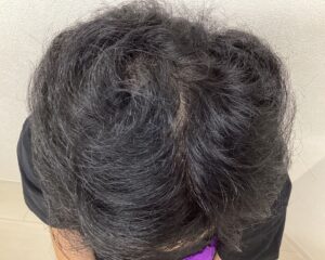 AGA治療12ヵ月経過　48歳男性　頭頂部　横浜院