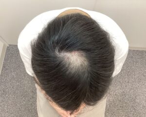 AGA治療前 28歳男性 前頭・頭頂部薄毛 新潟院