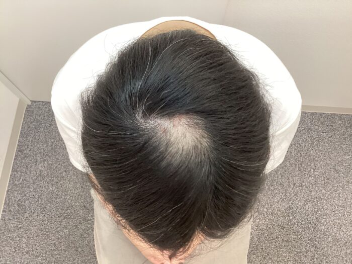 【28歳男性】前頭・頭頂部の薄毛がAGA治療で改善中｜新潟院