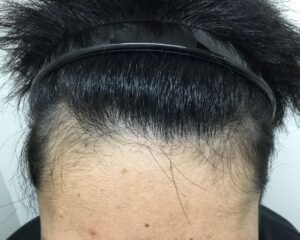 AGA治療後＿28歳男性＿生え際の改善＿大阪梅田院