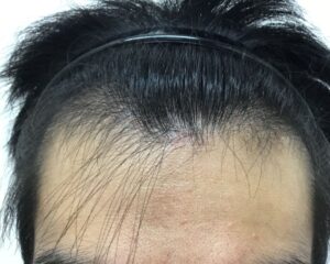 AGA治療後＿32歳男性＿生え際・頭頂部の改善＿大阪梅田院