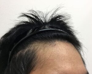 AGA治療後＿29歳男性＿生え際の改善＿大阪梅田院