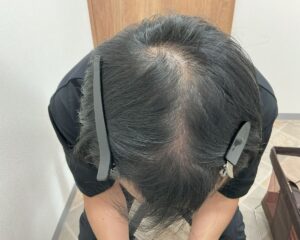 AGA治療後＿49歳男性＿生え際・頭頂部の改善_広島院