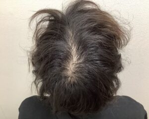 AGA治療後＿30歳男性＿生え際・頭頂部の改善＿広島院