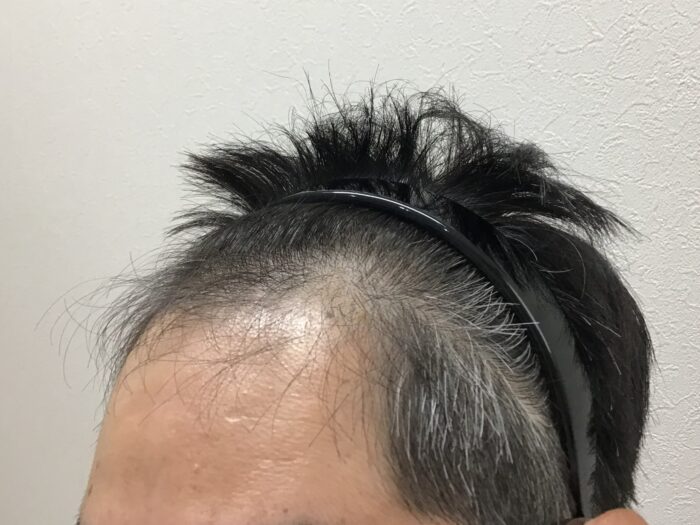 AGA治療前 48歳男性 M字薄毛 鹿児島院