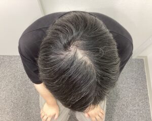 AGA治療1年後 28歳男性 前頭・頭頂部改善中 新潟院