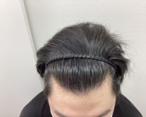 AGA治療1年後 28歳男性 前頭・頭頂部改善中 新潟院
