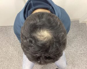 AGA治療4ヶ月後 38歳男性 生え際・頭頂部改善中 新潟院