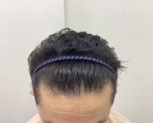 AGA治療1年後 38歳男性 生え際・頭頂部改善中 新潟院