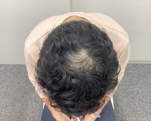 AGA治療1年後 38歳男性 生え際・頭頂部改善中 新潟院