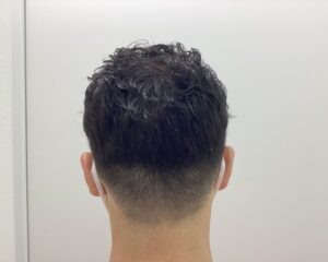 AGA治療1年後 38歳男性 生え際・頭頂部改善中 新潟院