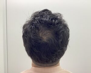 AGA治療1年後 38歳男性 生え際・頭頂部改善中 新潟院