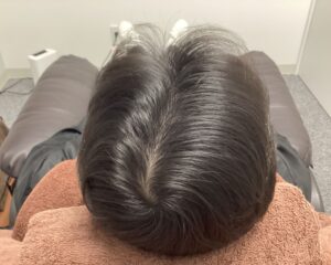 AGA治療3ヶ月後　42歳男性　生え際・頭頂部改善　新潟院
