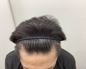 AGA治療11ヶ月後　42歳男性　生え際・頭頂部改善　新潟院