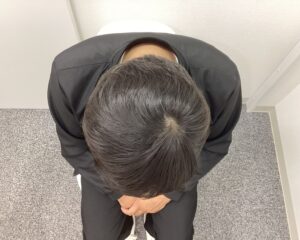 AGA治療11ヶ月後　42歳男性　生え際・頭頂部改善　新潟院